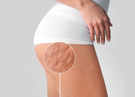 Selülit Nedir? Nasıl Geçer?