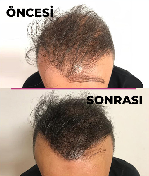 Saç Simülasyonu Ankara